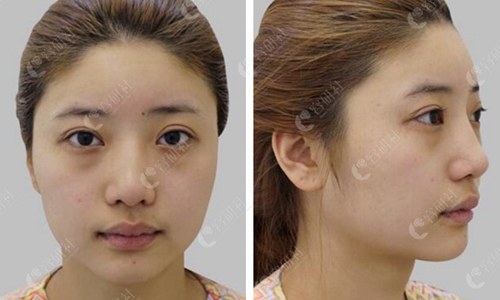 双眼皮疤痕明显能修复吗?分享韩国必当归眼修复+去眼袋案例