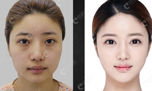 在韩国必当归Pitangui做全脸打造术前术后对比图