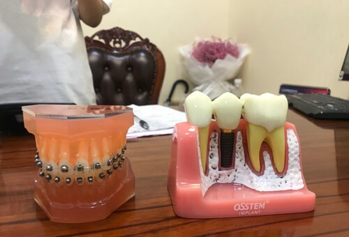 口腔种植牙模型