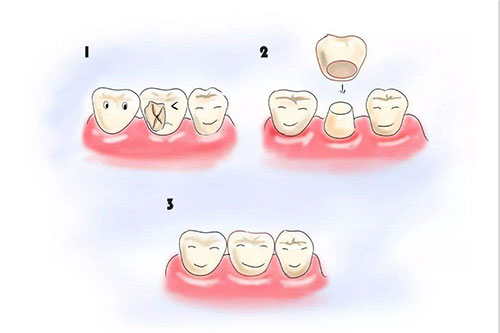 补牙情况示意图