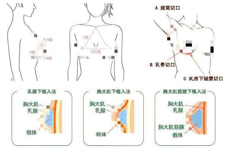 蘇國藝醫(yī)生隆胸原理