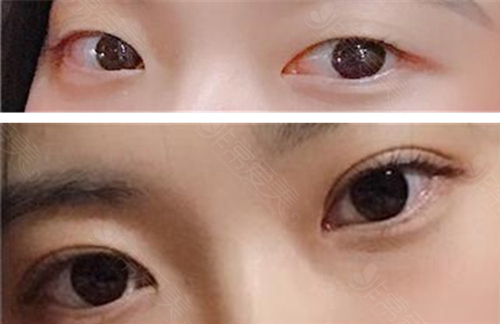 韩国李白整形外科眼部整形案例