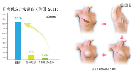 国外乳房再造手术方式调查对比