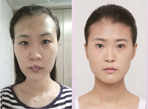 韩国珠儿丽下颌角缩小+颧骨颧弓整形术前