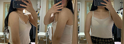 韩国Signature整形外科手臂综合吸脂案例
