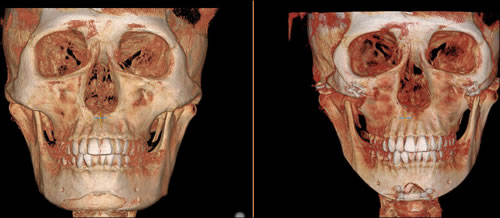 丽珍整形外科轮廓整形CT图片