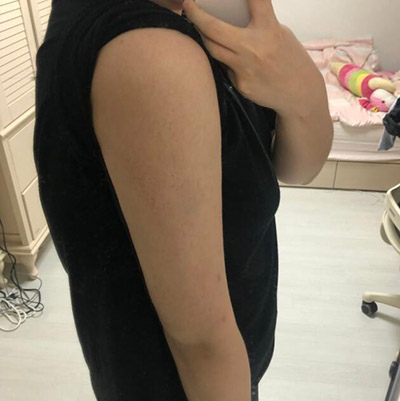 韩国Signature整形外科手臂吸脂一个月