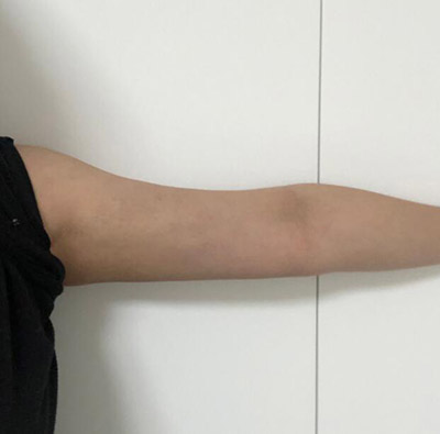 韩国Signature整形外科手臂吸脂两个月