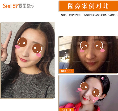 郑州辰星整形做鼻子是什么风格?多对比图带你了解!