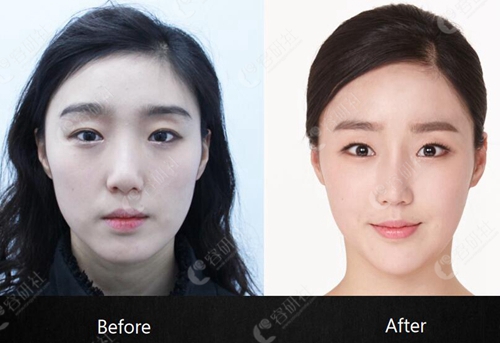 在韩国必当归做耳软骨隆鼻+面部脂肪填充术前术后对比