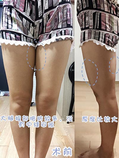 韩国宝士丽整形外科腿部吸脂术前