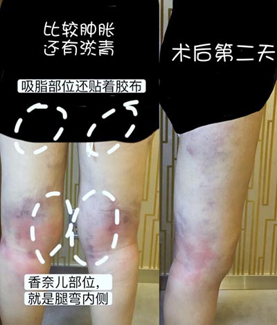 韩国宝士丽整形外科大腿吸脂第2天