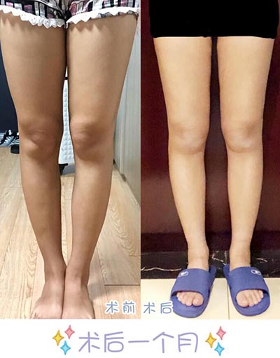 韩国宝士丽大腿吸脂术后一个月效果