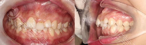 杭州美奥口腔王铭淏医生牙列拥挤矫正前