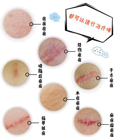 真皮再生术可以改善的疤痕种类
