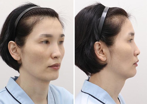 韩国NOTE整形外科轮廓三件套手术