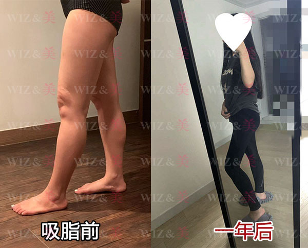 韩国wiz美大腿吸脂前后对比