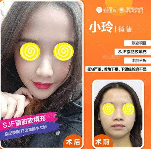 脂肪胶是什么?和自体脂肪相比有什么优势呢?成活率高吗?