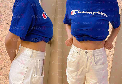 韩国WIZ美腰腹吸脂4个月照片