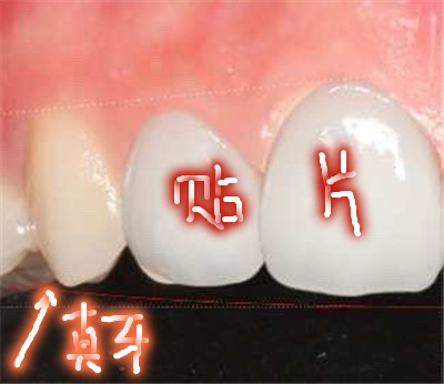 貴陽德韓口腔醫(yī)院瓷貼片<span style=