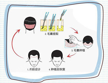 毛发移植过程示意图