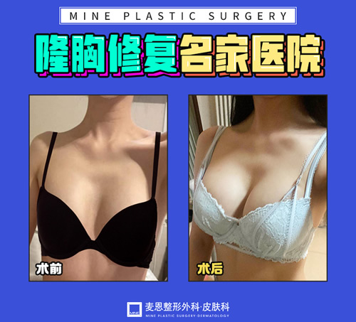 韩国麦恩假体隆胸修复展示