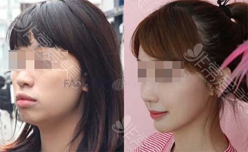 凸嘴小伙伴必看!正颌、正畸有没有区别?能不能一起做?