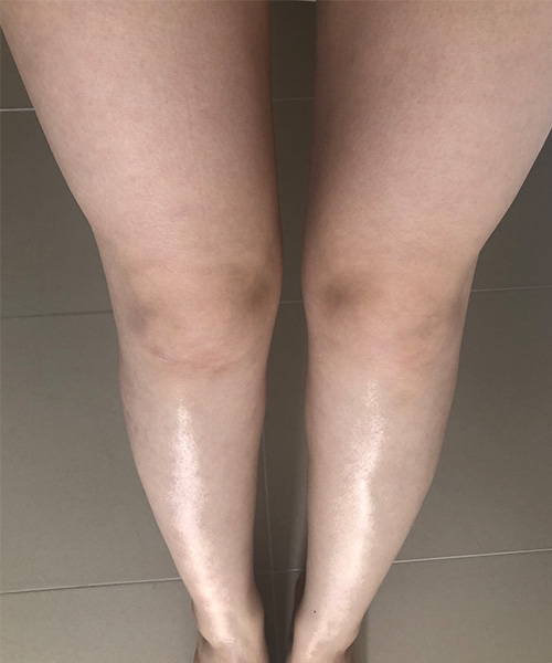西安画美整形大腿吸脂一个月