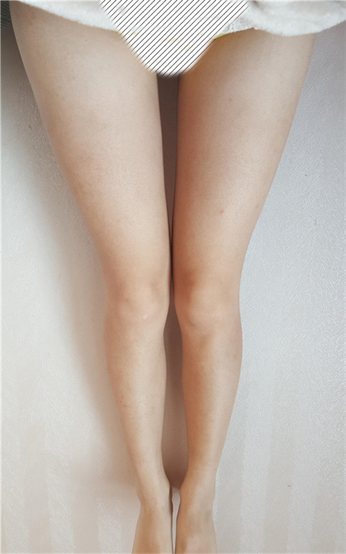 西安画美整形大腿吸脂1个月