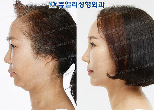 韩国珠儿丽整形外科面部抗衰照片