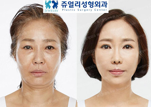 韩国珠儿丽整形外科面部抗衰案例