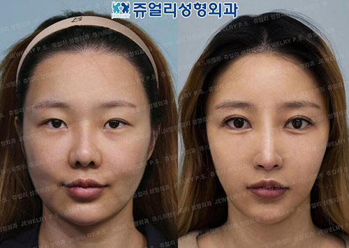 韩国珠儿丽面部吸脂前后对比