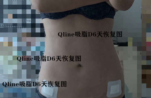 腰腹吸脂后第六天图 腰腹吸脂后第六天图