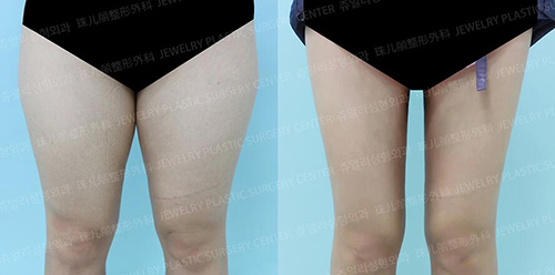 韩国珠儿丽整形吸脂瘦大腿照片