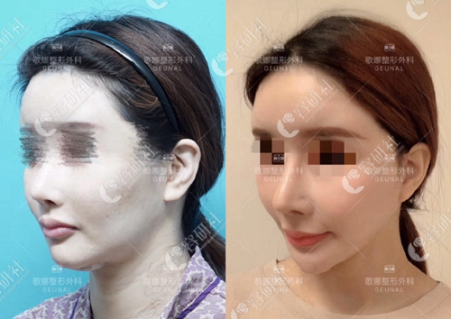 韩国歌娜整形外科拉皮手术案例