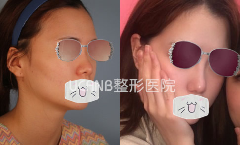 韩国Ucanb整形外科隆鼻案例