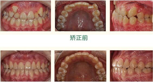 成都哪个医院正畸好又不贵?成都靠谱口腔门诊推荐!