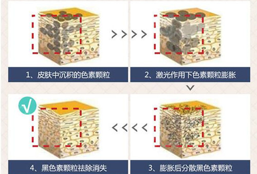 广州乳晕漂红手术，别让黑豆豆成为你的减分项