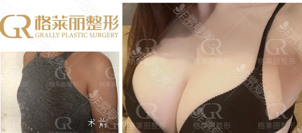 成都锦江格莱丽医疗美容双11玩美嗨购,双眼皮1099,隆鼻3499元!