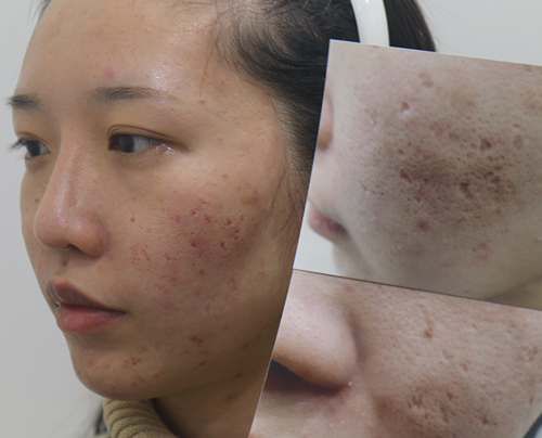 韩国陈整形外科治疗面部痘坑案例对比