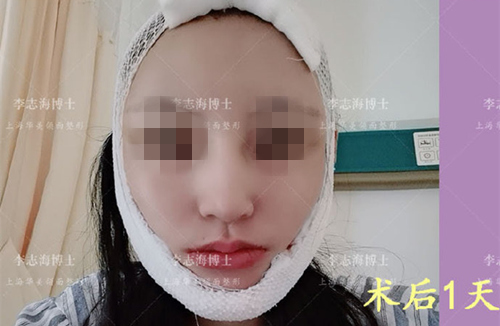 上海华美李志海下颌角截骨术后1天