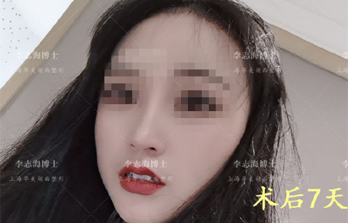 上海华美李志海下颌角截骨术后一周消肿情况