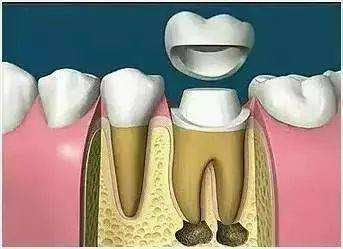 根管治疗带牙冠作用