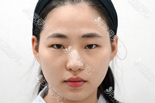 韩国wooahin整形外科隆鼻照片
