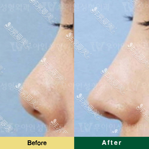 韩国自体软骨隆鼻修复照片