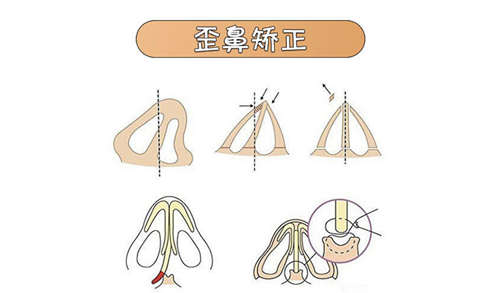 长春眼鼻修复好的医院分享，关于眼鼻修复日记价一定要看!