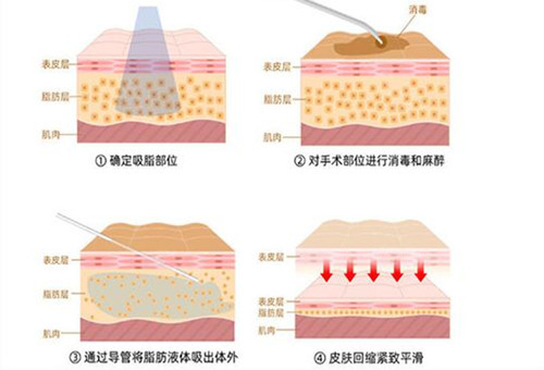 吸脂手术示意图