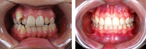 北京佳美口腔医院正畸对比照片