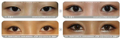 韩国特艺整形外科眼部手术日记