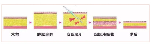 厦门薇格全身吸脂有后遗症吗？这些部位吸脂会反弹吗？